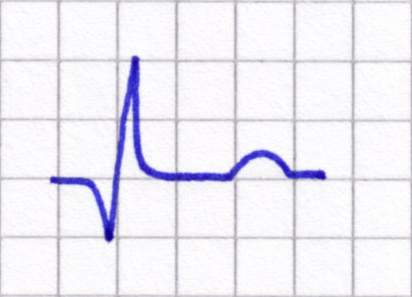 Datei:EKG Myokardinfarkt 4.JPG