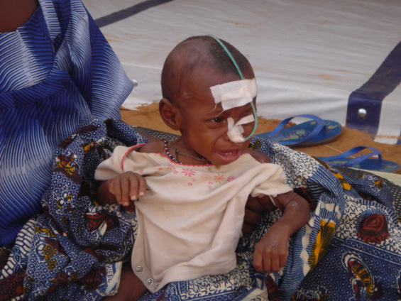 File:Starving Nigerian child.jpg