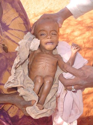 Plik:Malnourished child in Somalia.jpg