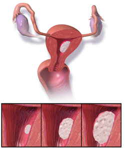 A diagram of the location and development of endometrial cancer