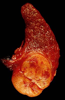 Follicular adenoma of the thyroid.jpg