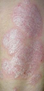 IMG:http://upload.wikimedia.org/wikipedia/commons/0/01/Psoriasis.jpg