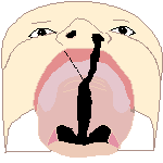cleft lip and palate left seen from bottom