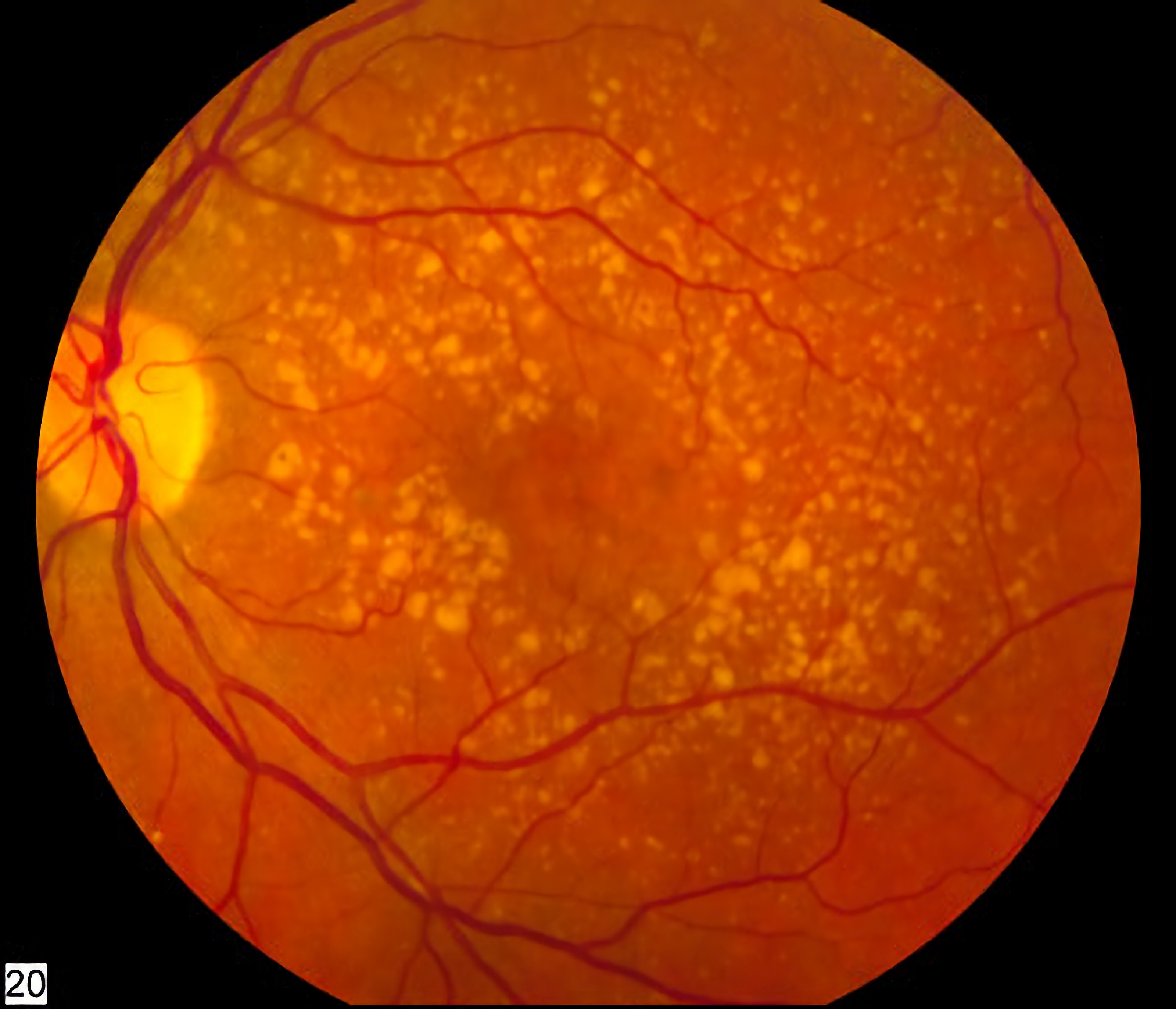 retina age-related macular degeneration fundus