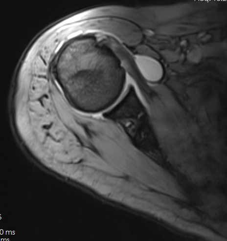 Shoulder MRI 141806