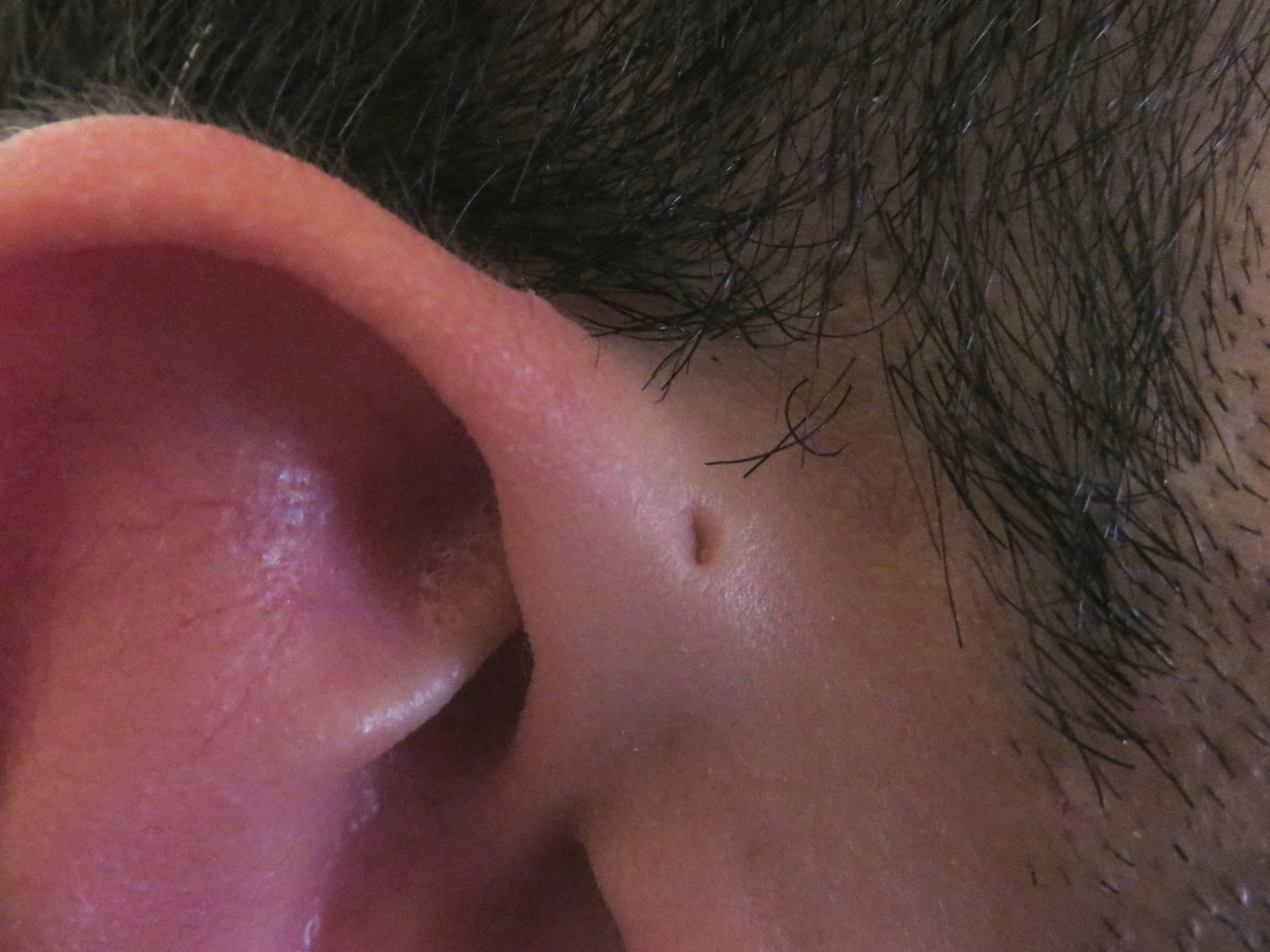 患有先天性耳前瘘管是一种怎样的体验？ - 知乎