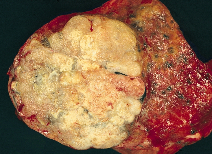 Adenocarcinoma polmonare, una forma di neoplasia maligna. Si noti la grande massa periferica, lobulata e dall'aspetto traslucido