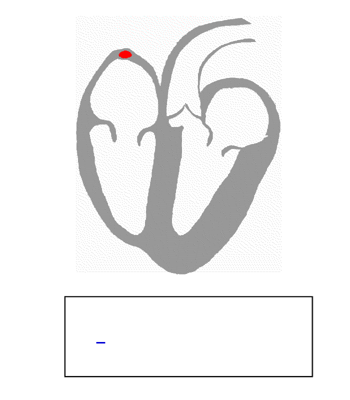 EKG - Schematische Darstellung des Prinzips der EKG-Darstellung (WIKIPEDIA)
