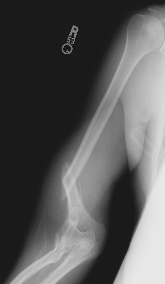 Arm X Ray