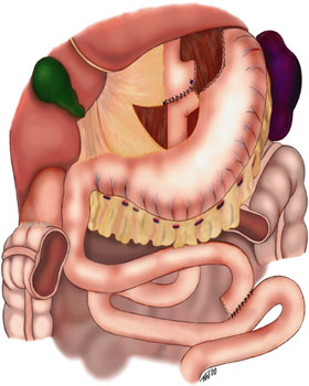 Graphic of a Gastric Bypass, Roux en-Y