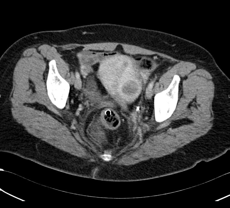File:Uterine fibroid CT.JPG - Wikimedia Commons