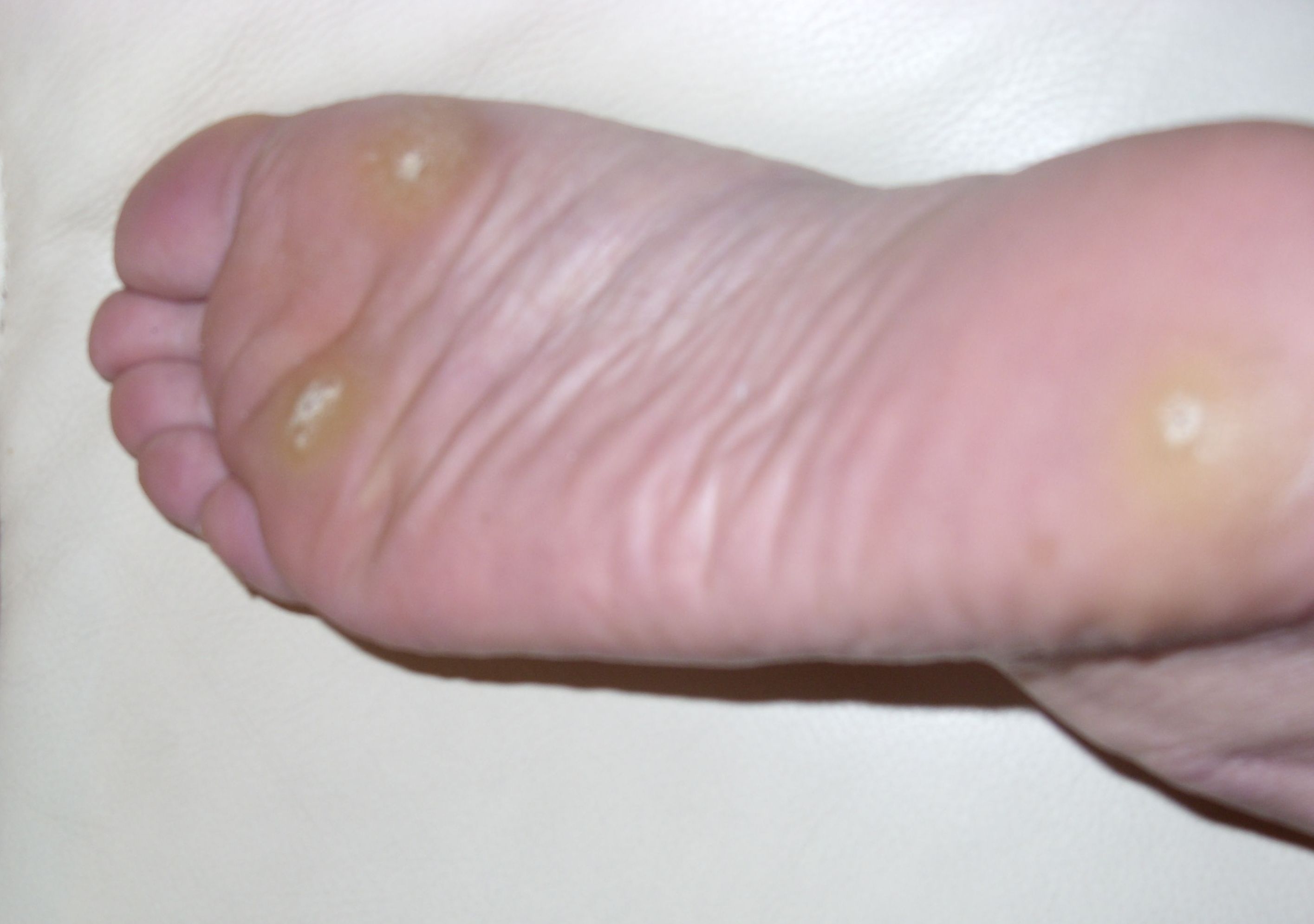 Plantar Warts Kids