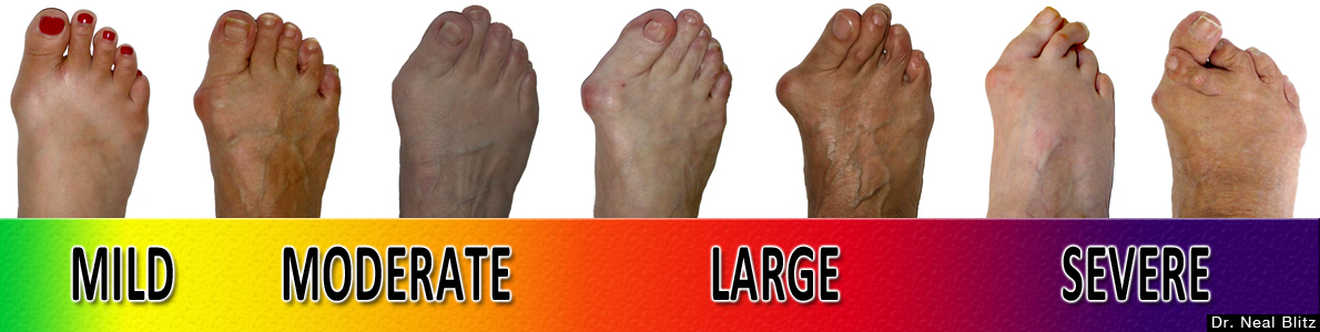 shoes Description Progression Bunion Scale.jpg for pain foot