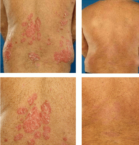 http://upload.wikimedia.org/wikipedia/commons/2/21/Psoriasis_infliximab_ar1182-2.gif
