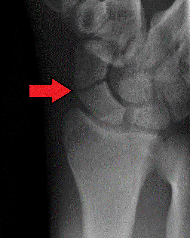 X-ray Image from Wikipedia