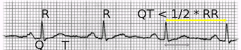 Falls QT < 1/2 RR dann ist QT normal