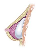 1 English - Breast after subglandular augmenta...