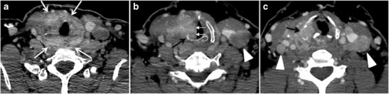 Fig. 6. A 61-year-old female patient with locally aggressive PTC. an Enhanced axial CT scan of the neck demonstrates a heterogeneous infiltrative thyroid mass. This mass diffusely involves the entire gland and circumferentially encases the trachea with involvement of bilateral tracheoesophageal grooves (white arrows). b, c Additional axial cranial images show right cricoid cartilage destruction (black arrows in b), right thyroid cartilage destruction (black arrow in c), right vocal cord paralysis (white arrows in b), and bilateral cervical lymphadenopathy (arrowheads).[1]