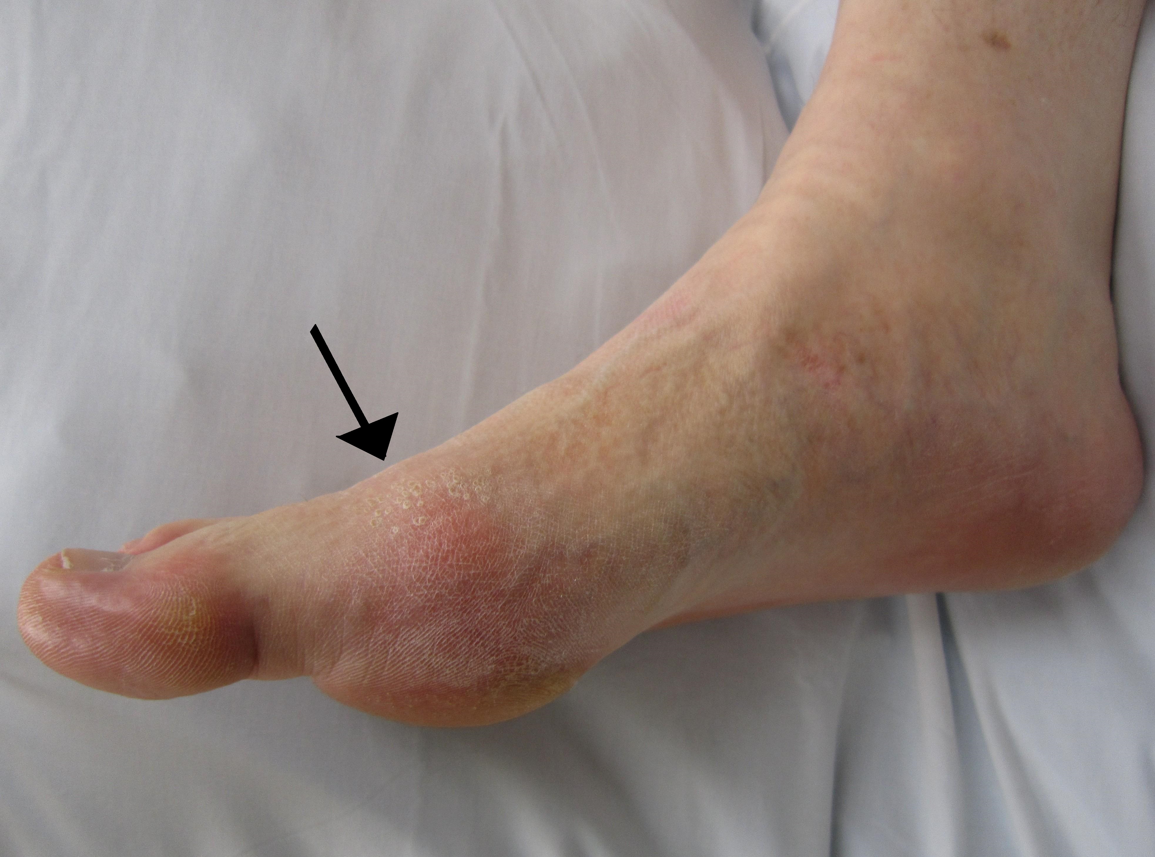 Alfa img - Showing &gt; Blood Poisoning Rash On Foot