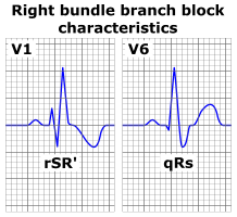 خصائص تخطيط القلب لإحصار الحزيمة اليمنى النموذجي تظهر تجمعات QRS واسعة مع موجة R نهائية في ليد V1 وموجة S مبهمة في ليد V6.
