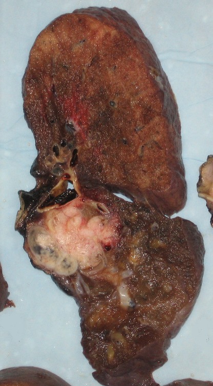 lung cancer picture
