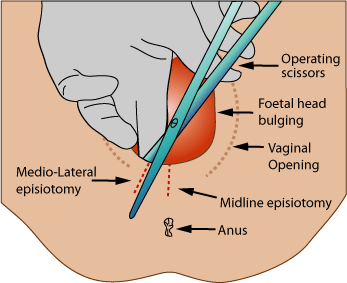 Medio-lateral-episiotomy