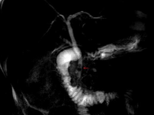 Hida scan and pancreatic cancer