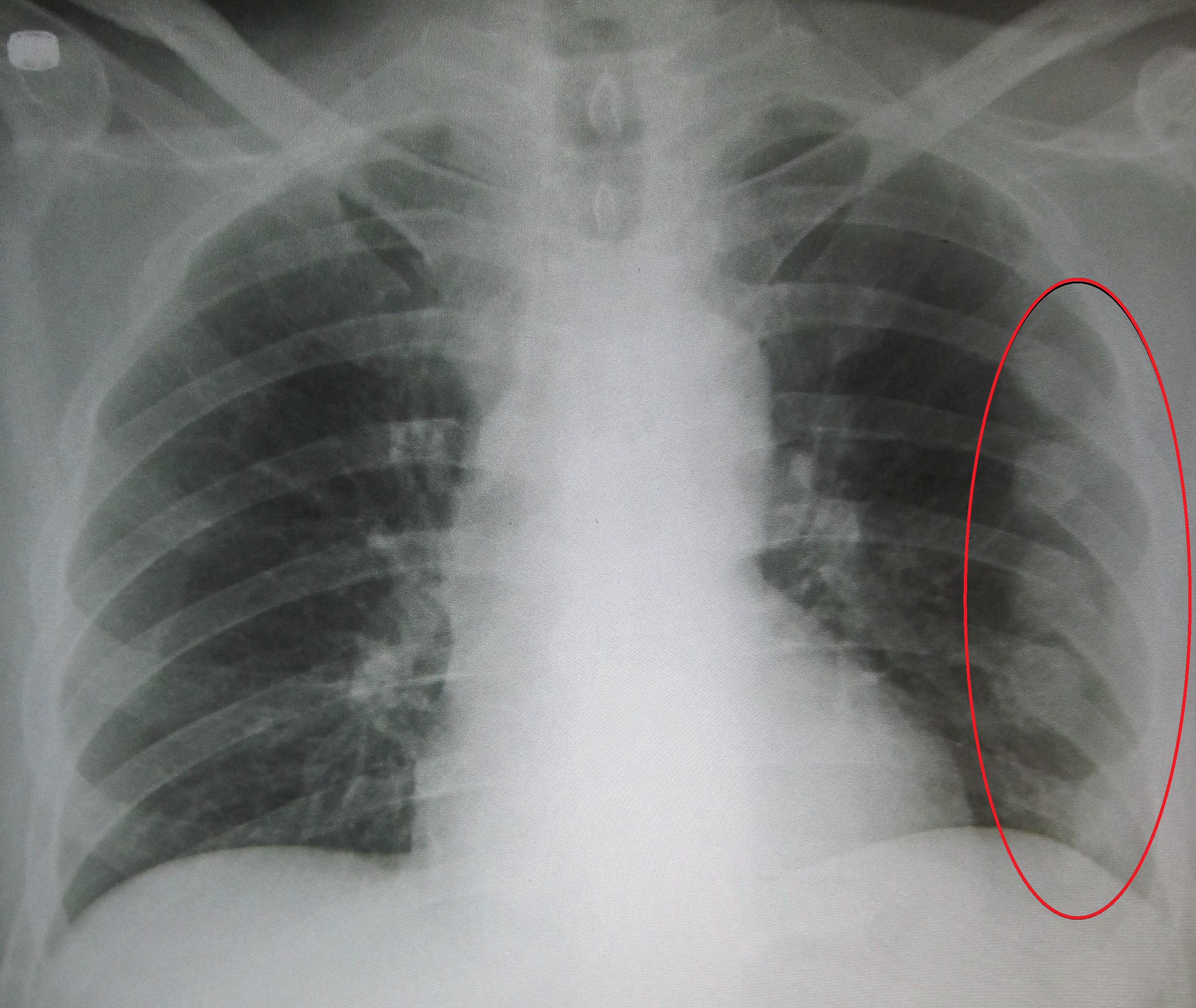 An X ray showing multiple old fractured ribs of the person's left side as marked by the oval.