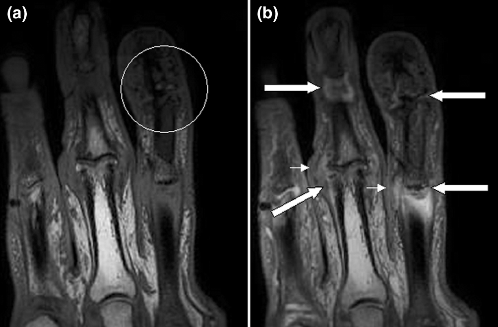 Magnetic resonance images of the fingers in psoriatic arthritis.