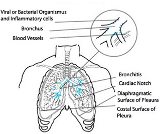 inhaler for bronchitis little one
