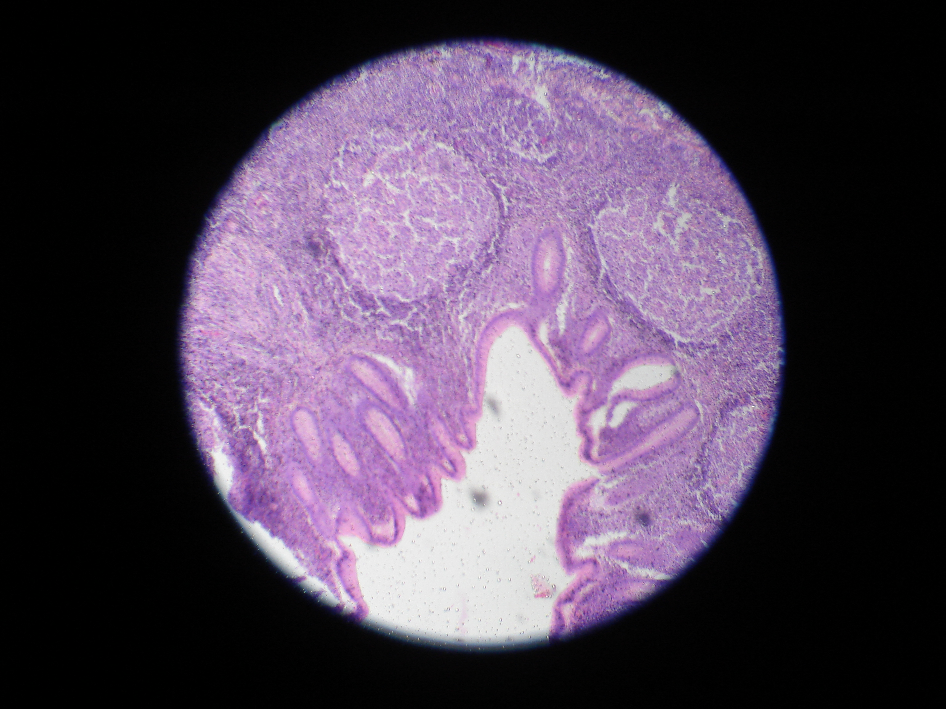 acute appendicitis histopathology