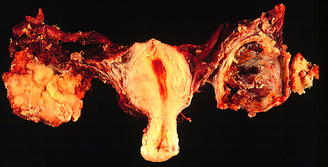 Tumor On Ovary