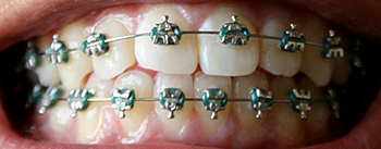 Dental braces small
