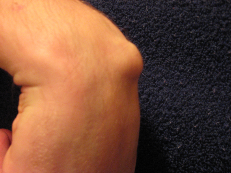 I cant even take a snap of my disgusting ganglion cyst that is on my wrist.