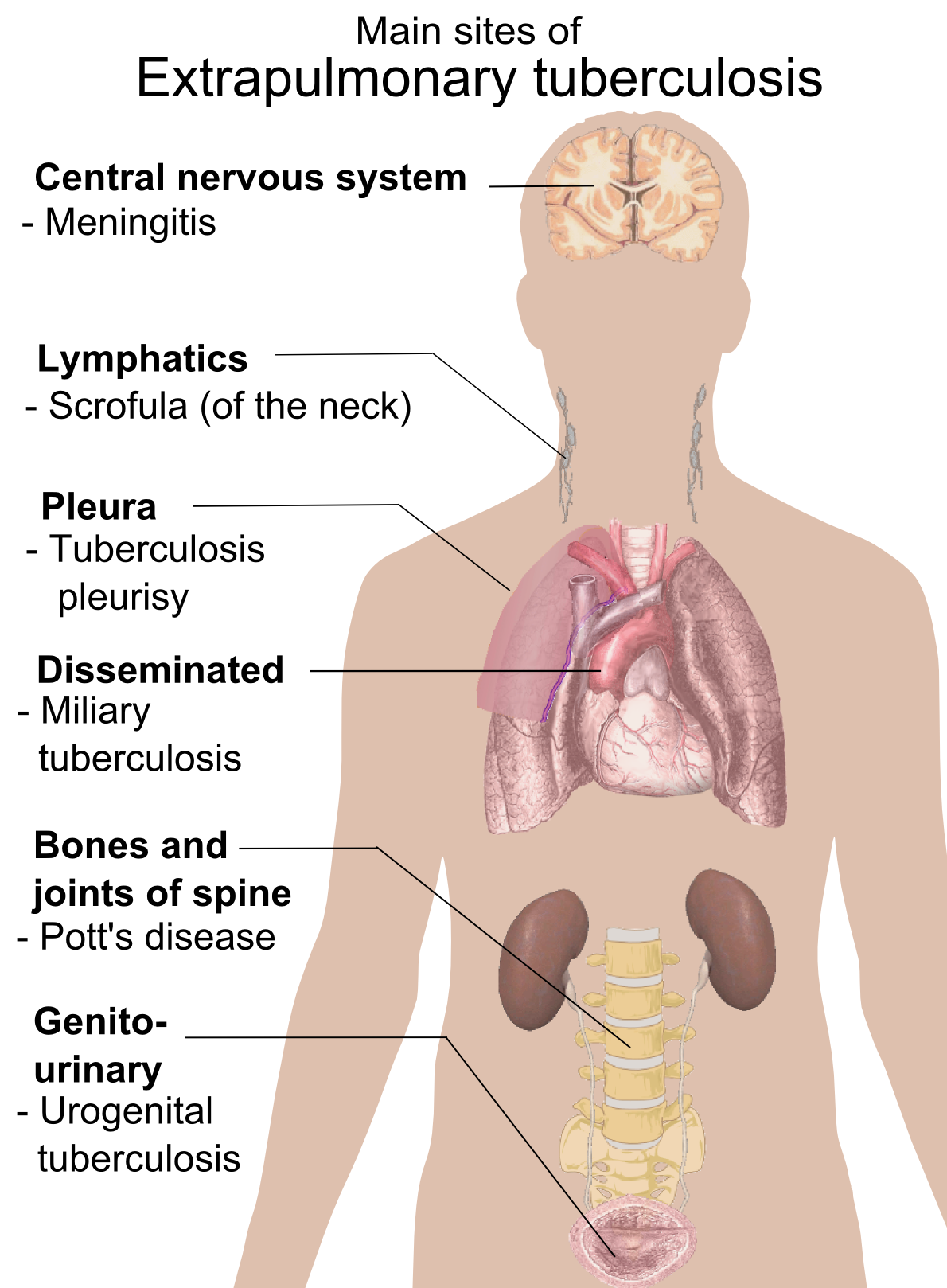 http://upload.wikimedia.org/wikipedia/commons/4/49/Extrapulmonary_tuberculosis_symptoms.png