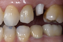 corona su impianto dentale zirconia