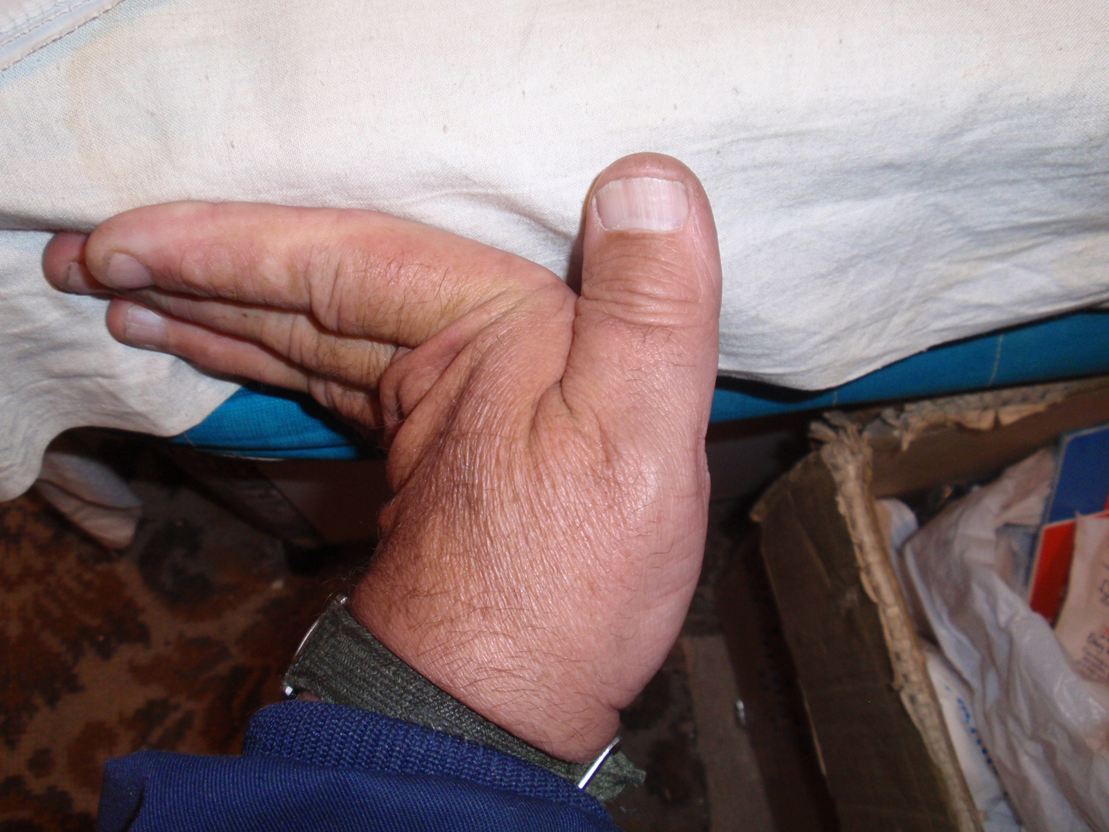 Hypermobile fingers -- they bend backwards to 90 degrees. By Anthony Appleyard [Public domain], via Wikimedia Commons