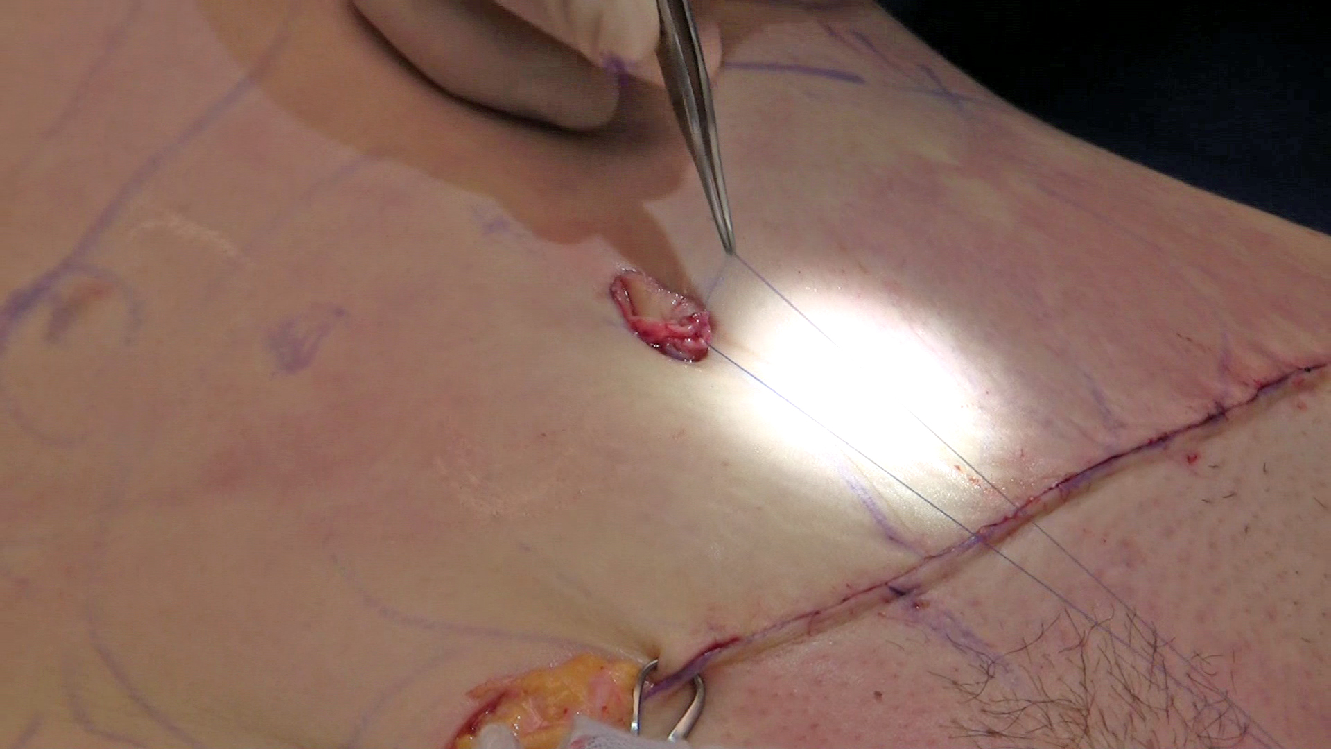 Belly Button Reconstruction
