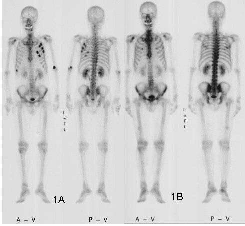 99mTc-HMDP bone scintigraphy 01
