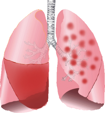 Lobar pneumonia