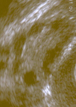 Polycystic Ovary by Sonography.