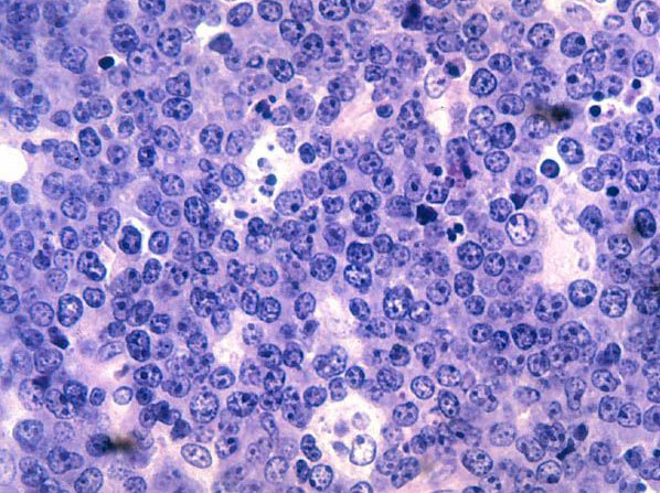 File:Burkitt's lymphoma Histopathology.jpg