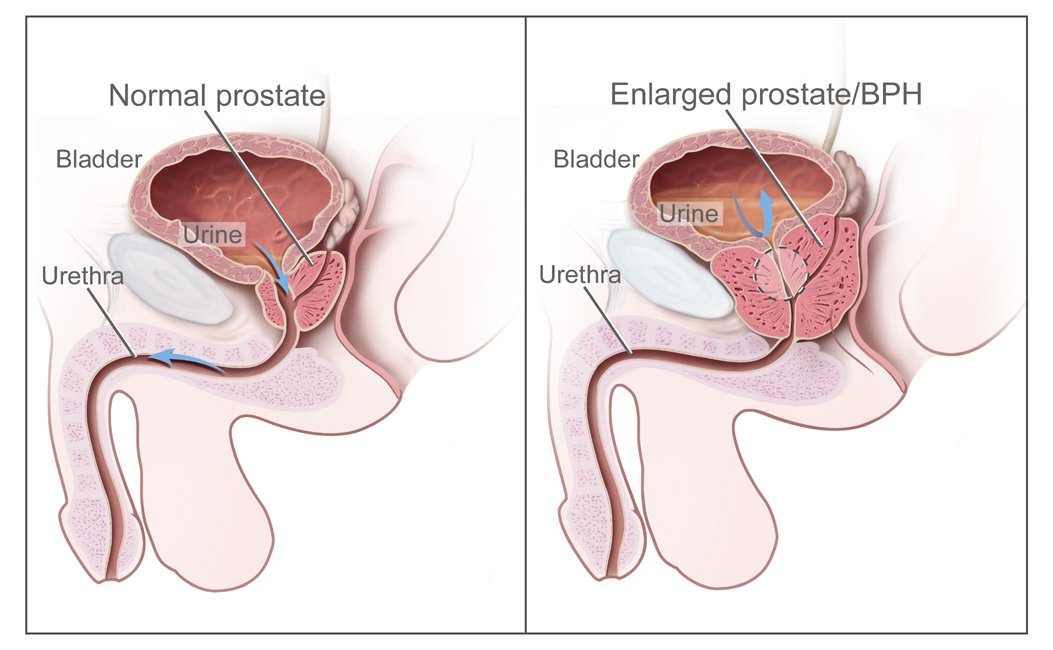 benign prostatic hypertrophy / BPH 