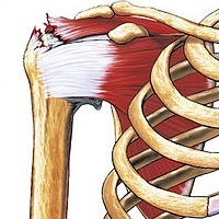 Here is where the rotator cuff is located, and what a tear would look like in the shoulder Rotator cuff tear.jpg