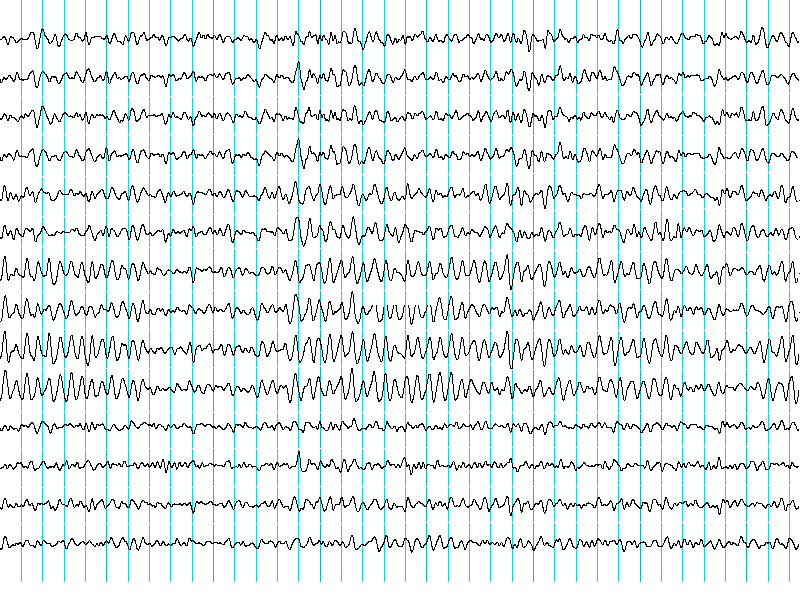 encephalogram