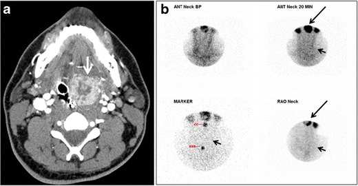 Fig. 18. Lingular thyroid in a 33-year-old male who presented with oropharyngeal bleeding. an Axial enhanced neck CT scan at the level of mandible demonstrates a 3 × 3 × 3.4 cm round, partly well-delineated, heterogeneously enhancing lesion (white arrow). It is predominantly on the left side of the oropharynx and to some extent at the mid part of the base of the tongue. The thyroid gland was normal (not shown). b Image of the anterior face and neck taken 20 minutes after Tc99m-Pertechnetate injection shows absent thyroid radiotracer uptake in normal thyroid anatomical location (black short arrows). There is an area of increased uptake (long black arrows) corresponding to the posterior tongue mass identified on CT scan.[1]