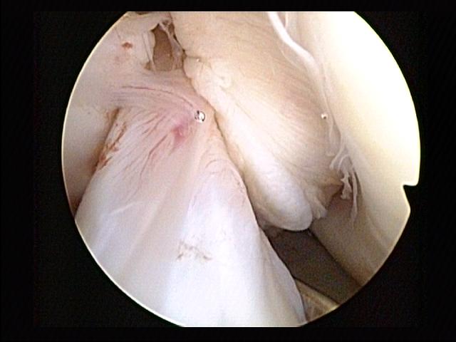 Anterior cruciate ligament (surrounded by synovium) during knee arthroscopy. Lateral epicondylus of the femur can be seen to the right.