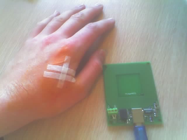 Rfid_implant_after.jpg