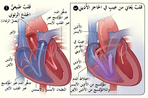 Atrial septal defect with left-to-right shunt