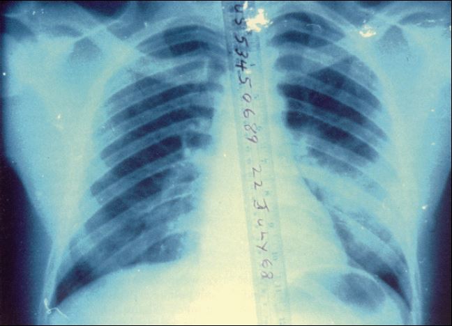 Chest radiograph